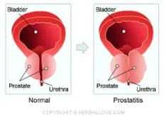 Menyembuhkan Prostat Bengkak
